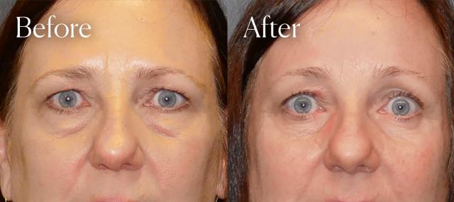 Brow Lift result at Shah Aesthetic Surgery - Rhinoplasty and Facelift Specialist in Englewood, CO