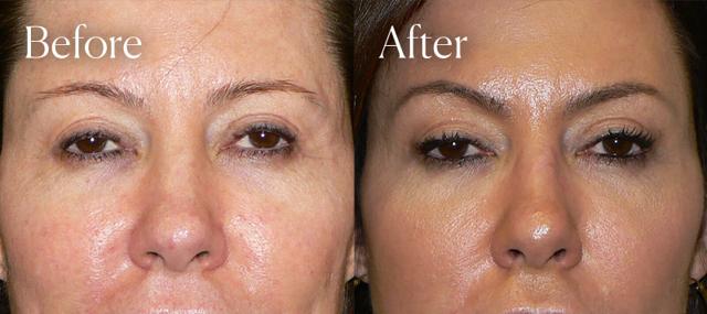 Brow Lift result at Shah Aesthetic Surgery - Rhinoplasty and Facelift Specialist in Englewood, CO