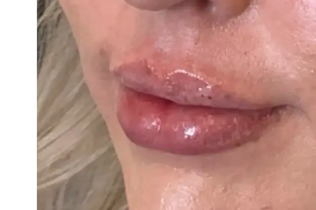 Lip Filler after at Royale Aesthetics and Beauty in Ogden, UT