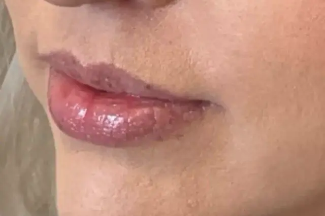 Lip Filler before at Royale Aesthetics and Beauty in Ogden, UT