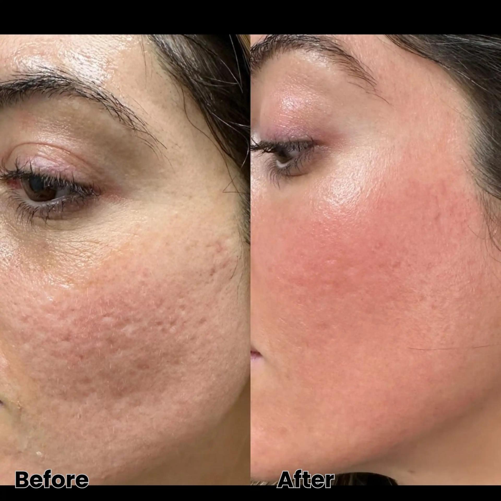 Royale Aesthetics and Beauty laser treatment result — Ogden, UT