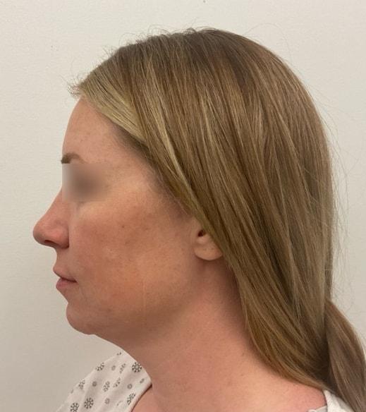 Neck Lift before at Royale Aesthetics and Beauty in Ogden, UT