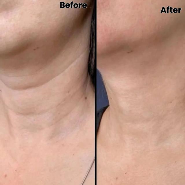 Microneedling result at Royale Aesthetics and Beauty in Ogden, UT