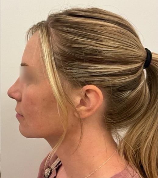 Neck Lift after at Royale Aesthetics and Beauty in Ogden, UT
