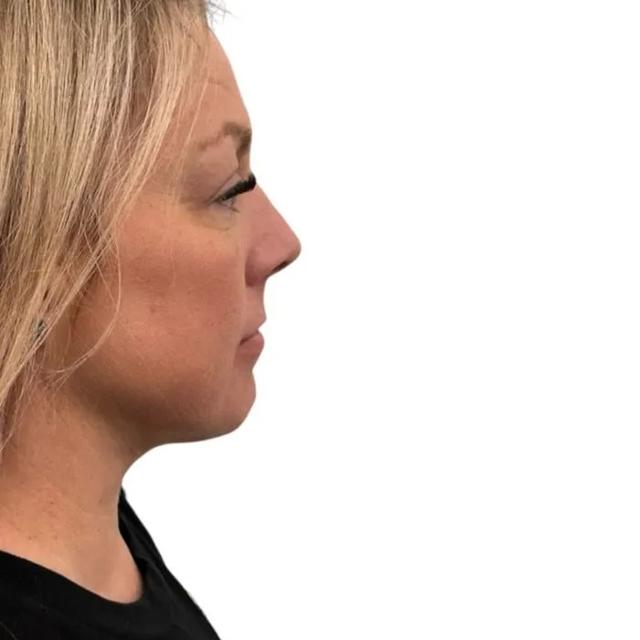 Neck Liposuction after at Royale Aesthetics and Beauty in Ogden, UT
