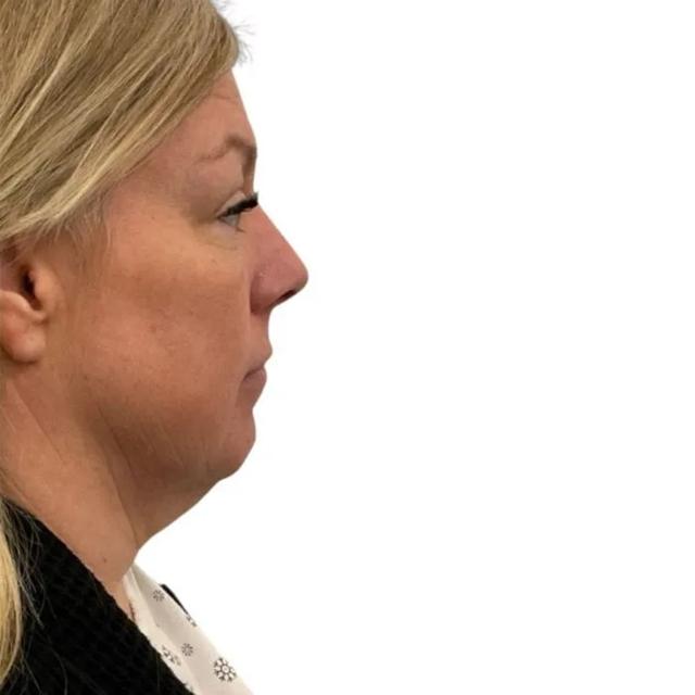 Neck Liposuction before at Royale Aesthetics and Beauty in Ogden, UT