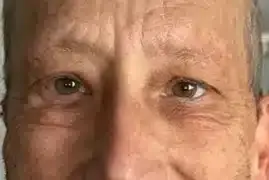 Blepharoplasty after at Royale Aesthetics and Beauty in Ogden, UT