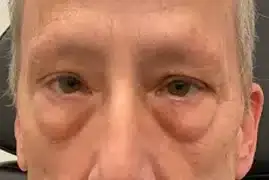 Blepharoplasty before at Royale Aesthetics and Beauty in Ogden, UT