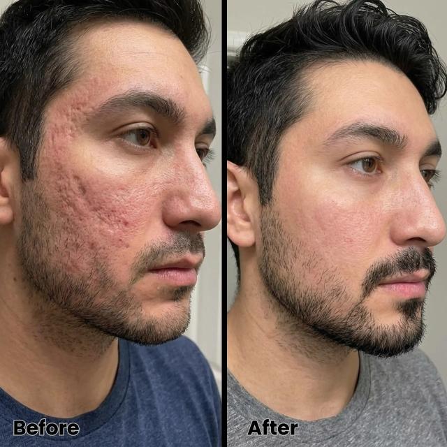 Laser Skin Resurfacing result at Royale Aesthetics and Beauty in Ogden, UT