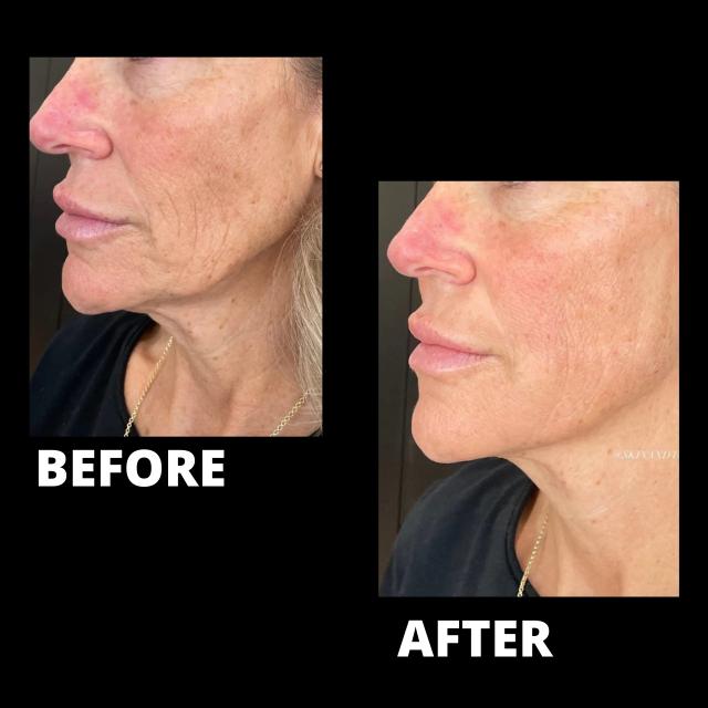 Dermal Fillers result at Royale Aesthetics and Beauty in Ogden, UT