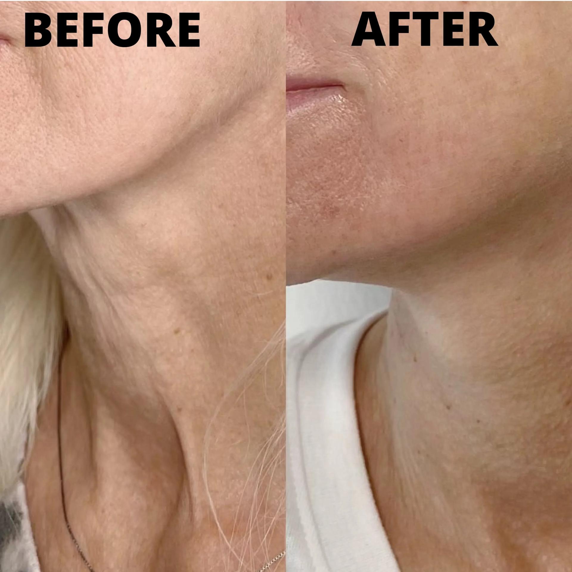 Royale Aesthetics and Beauty morpheus8 result — Ogden, UT