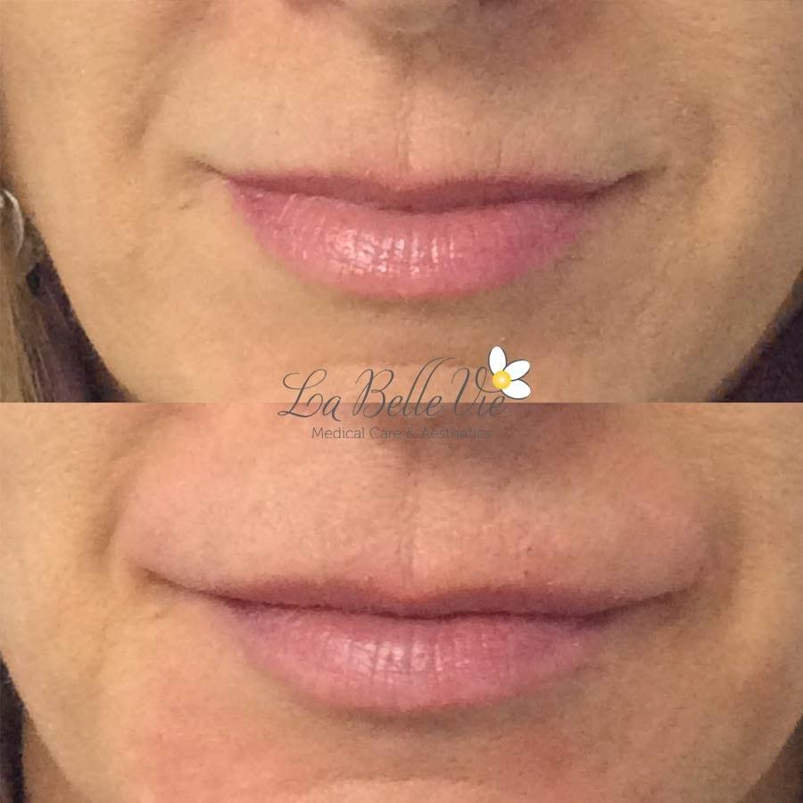 La Belle Vie Medical Care & Aesthetics lip filler result — Sandy, UT