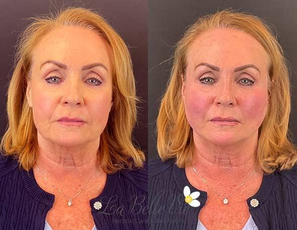 La Belle Vie Medical Care & Aesthetics cheek filler result — Sandy, UT