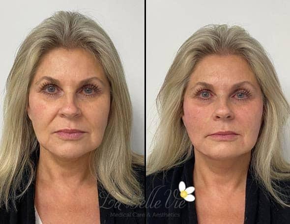 La Belle Vie Medical Care & Aesthetics cheek filler result — Sandy, UT