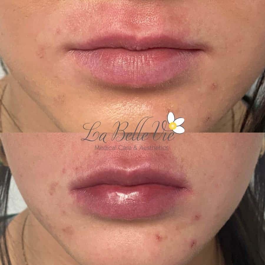 La Belle Vie Medical Care & Aesthetics lip filler result — Sandy, UT