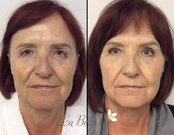 Botox result at La Belle Vie Medical Care & Aesthetics in Draper, UT