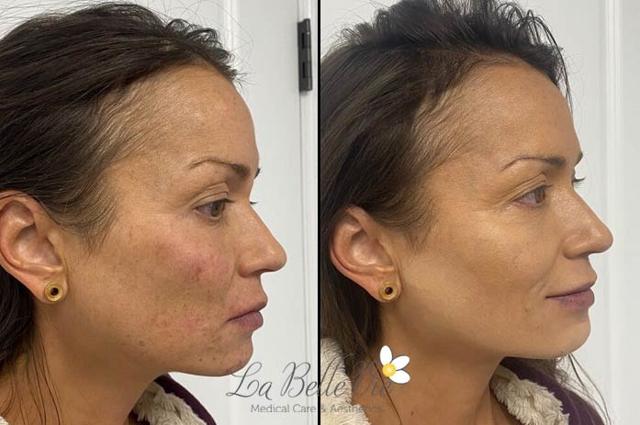 Laser Skin Resurfacing result at La Belle Vie Medical Care & Aesthetics in Draper, UT