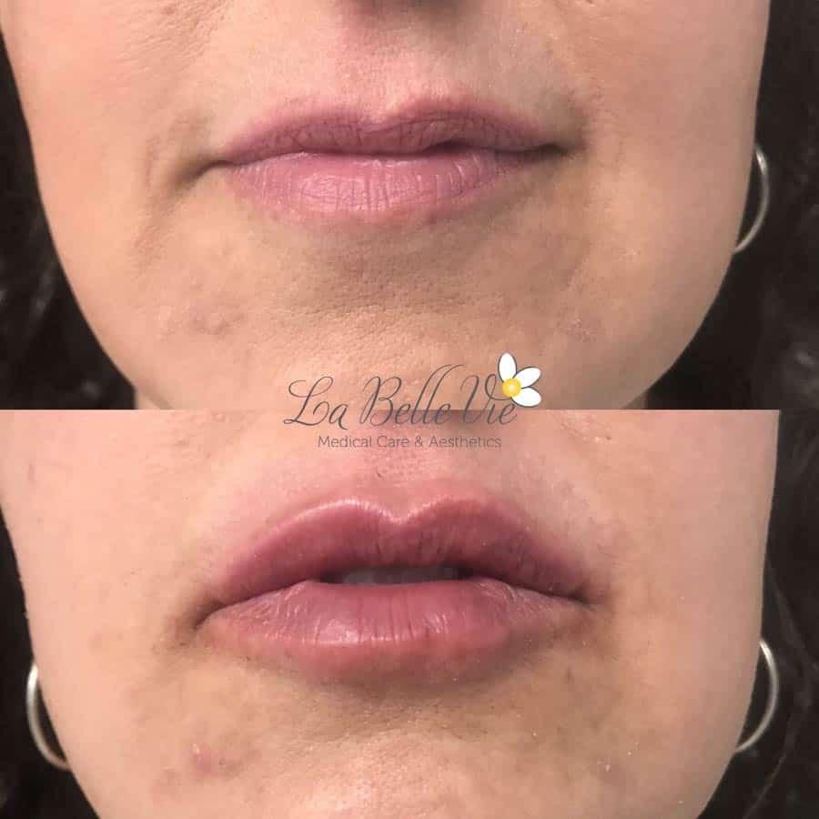 La Belle Vie Medical Care & Aesthetics lip filler result — Sandy, UT