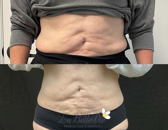 CoolSculpting result at La Belle Vie Medical Care & Aesthetics in Draper, UT