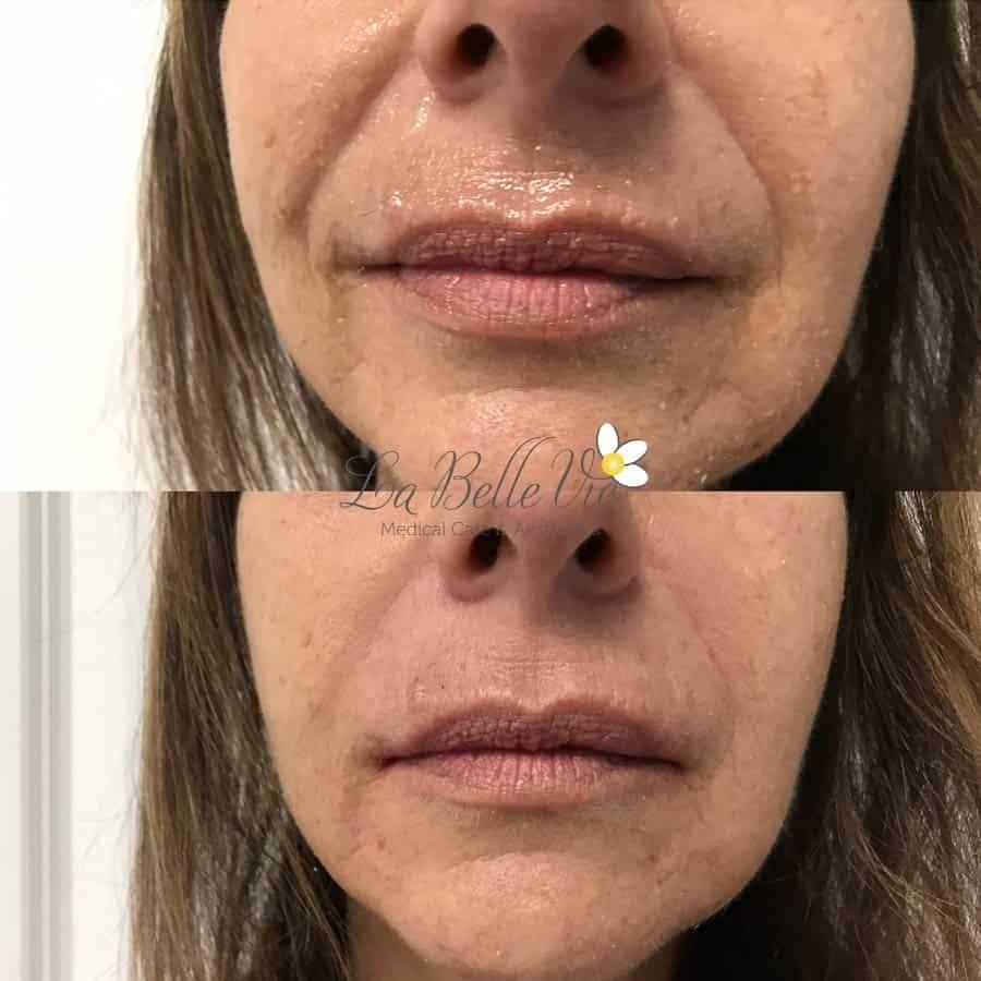 La Belle Vie Medical Care & Aesthetics lip filler result — Sandy, UT