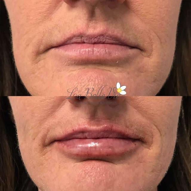 Lip Filler result at La Belle Vie Medical Care & Aesthetics in Sandy, UT