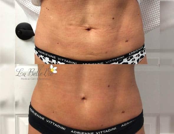 CoolSculpting result at La Belle Vie Medical Care & Aesthetics in Draper, UT