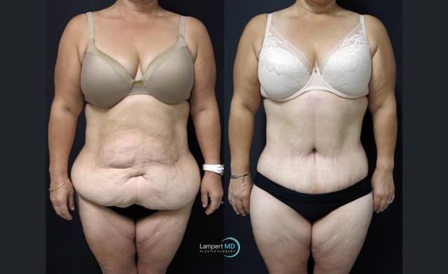 Mini Tummy Tuck result at Dr. Joshua Lampert Plastic Surgery in Aventura, FL