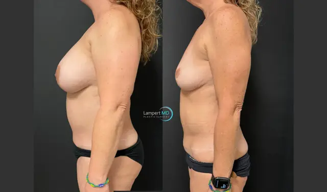 Mommy Makeover result at Dr. Joshua Lampert Plastic Surgery in Aventura, FL