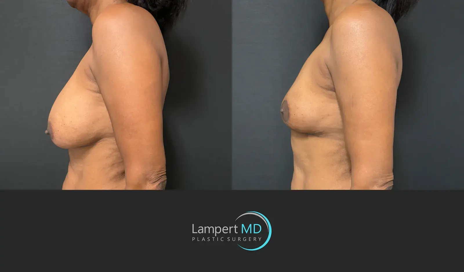 Dr. Joshua Lampert Plastic Surgery breast implant removal result — Aventura, FL