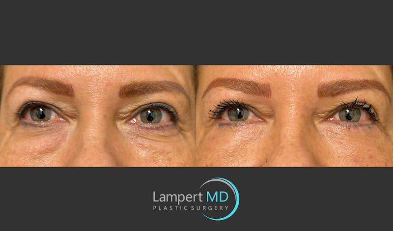 Dr. Joshua Lampert Plastic Surgery blepharoplasty result — Miami, FL