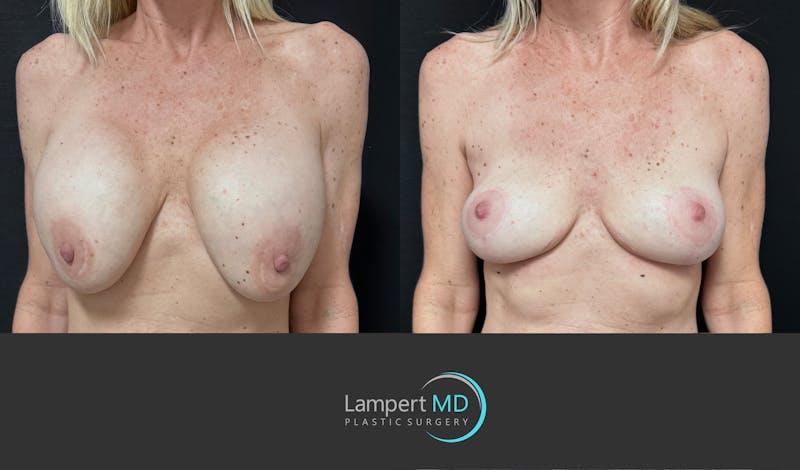 Dr. Joshua Lampert Plastic Surgery breast lift result — Aventura, FL