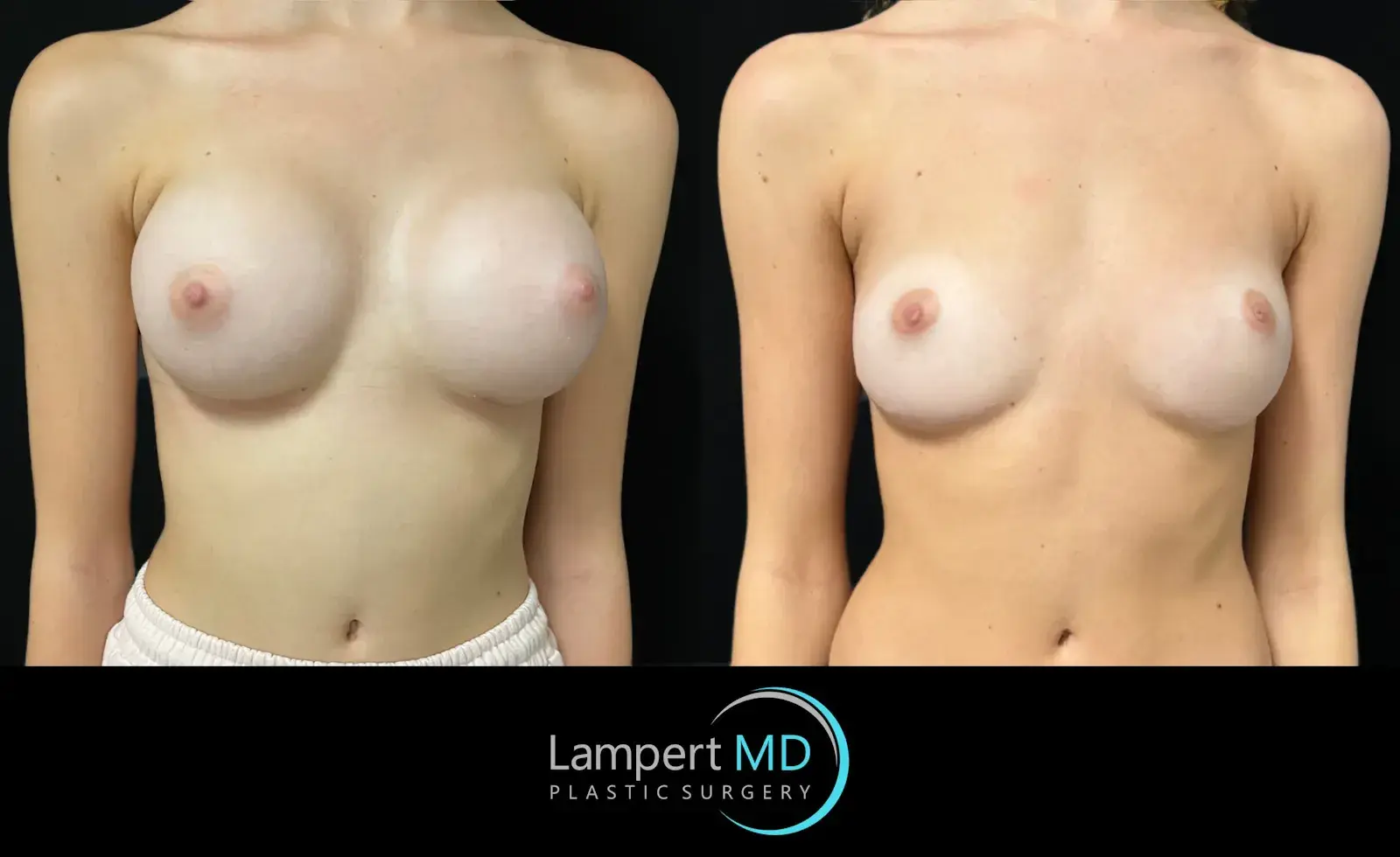 Dr. Joshua Lampert Plastic Surgery breast implant removal result — Aventura, FL