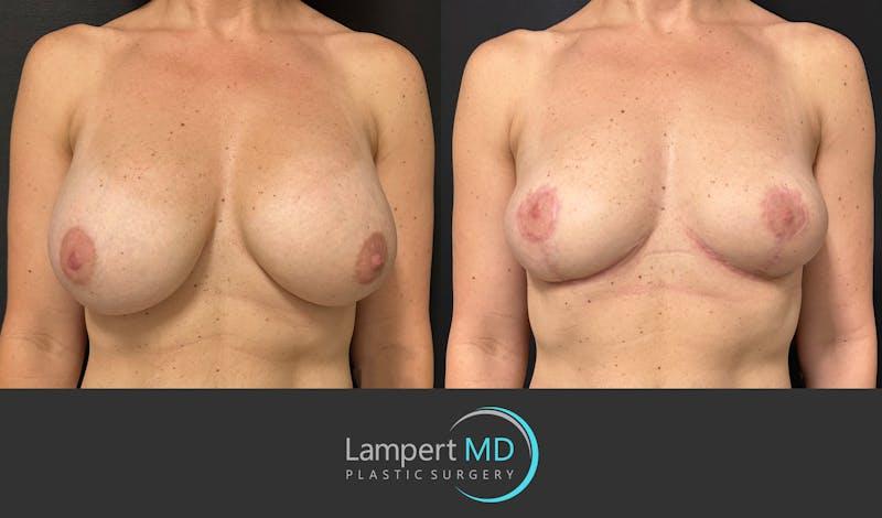 Dr. Joshua Lampert Plastic Surgery breast lift result — Aventura, FL