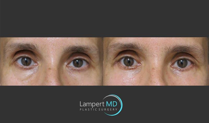 Dr. Joshua Lampert Plastic Surgery blepharoplasty result — Miami, FL