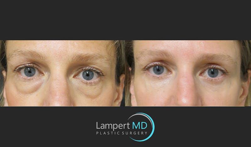 Dr. Joshua Lampert Plastic Surgery blepharoplasty result — Miami, FL