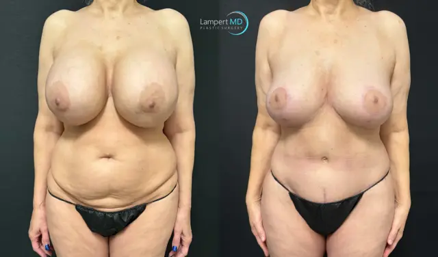Mommy Makeover result at Dr. Joshua Lampert Plastic Surgery in Aventura, FL