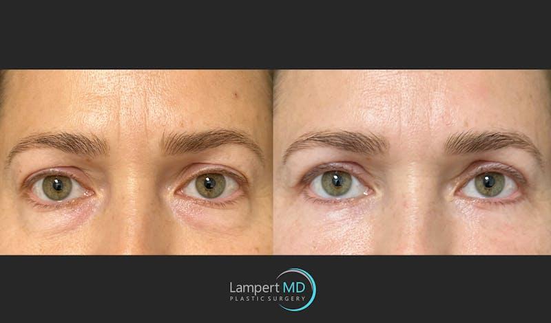 Dr. Joshua Lampert Plastic Surgery blepharoplasty result — Miami, FL