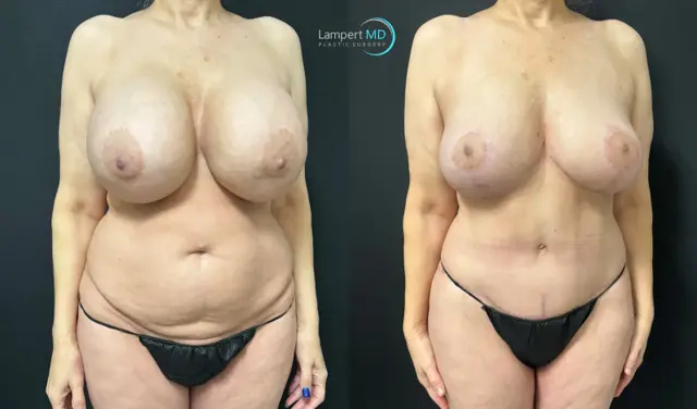 Mommy Makeover result at Dr. Joshua Lampert Plastic Surgery in Aventura, FL