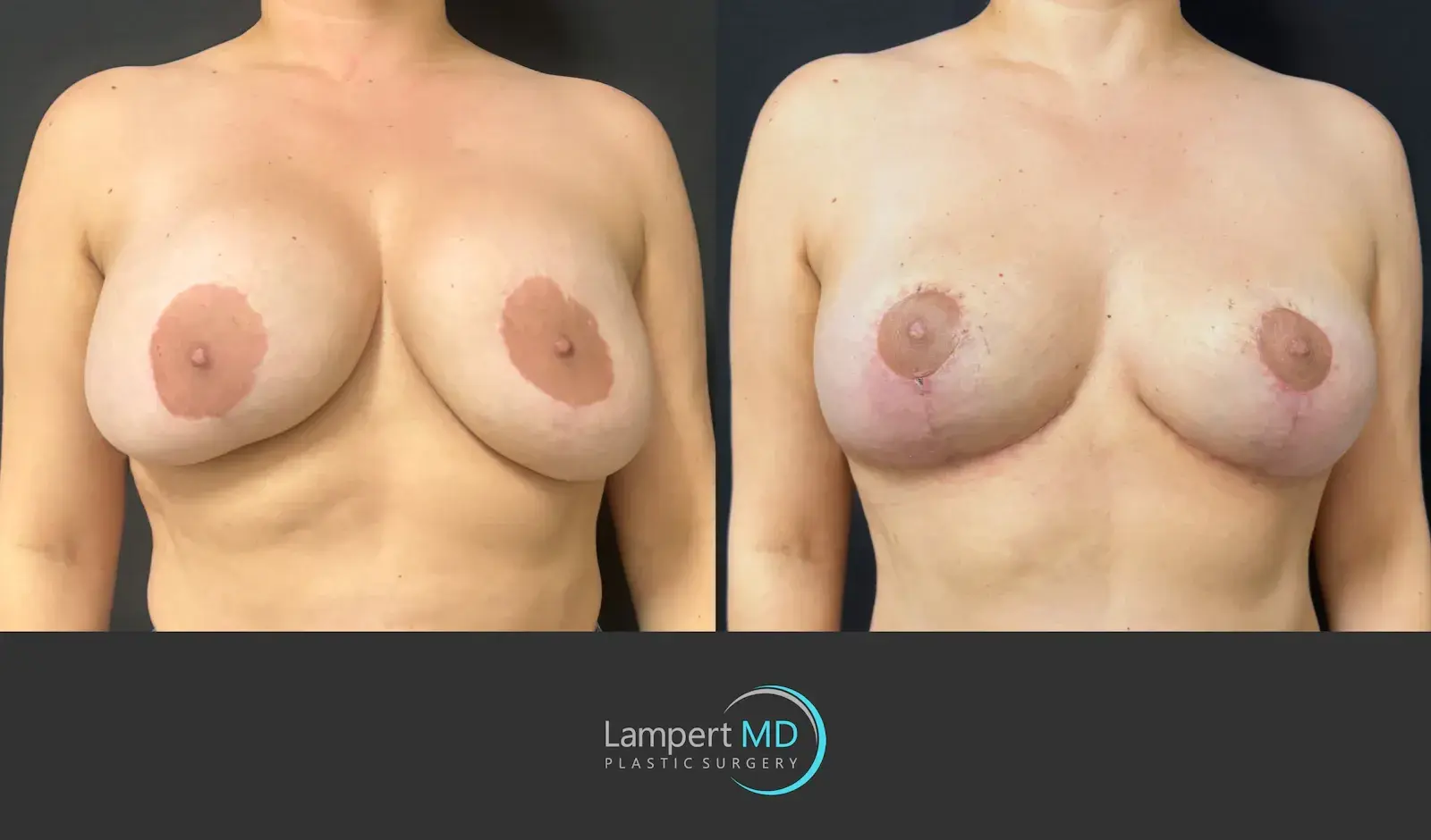 Dr. Joshua Lampert Plastic Surgery breast implant removal result — Aventura, FL