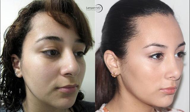 Functional Rhinoplasty result at Dr. Joshua Lampert Plastic Surgery in Aventura, FL