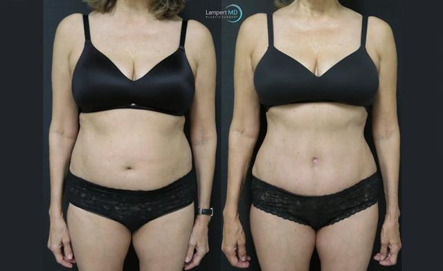 Mommy Makeover result at Dr. Joshua Lampert Plastic Surgery in Aventura, FL