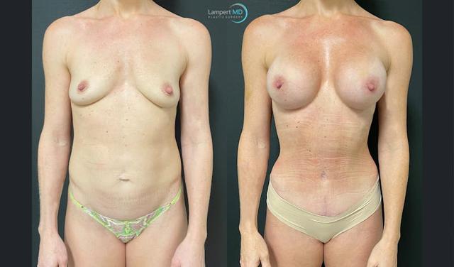 Mommy Makeover result at Dr. Joshua Lampert Plastic Surgery in Aventura, FL