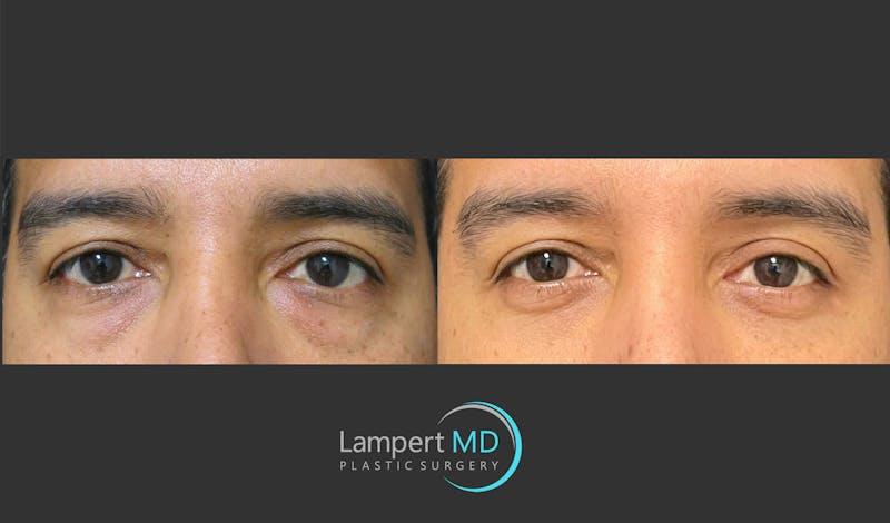 Dr. Joshua Lampert Plastic Surgery blepharoplasty result — Miami, FL