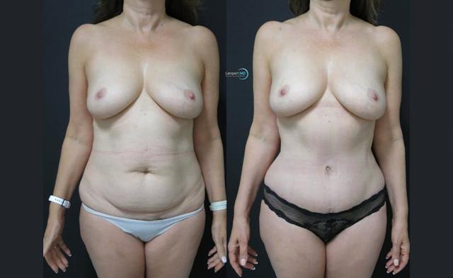 Mini Tummy Tuck result at Dr. Joshua Lampert Plastic Surgery in Aventura, FL