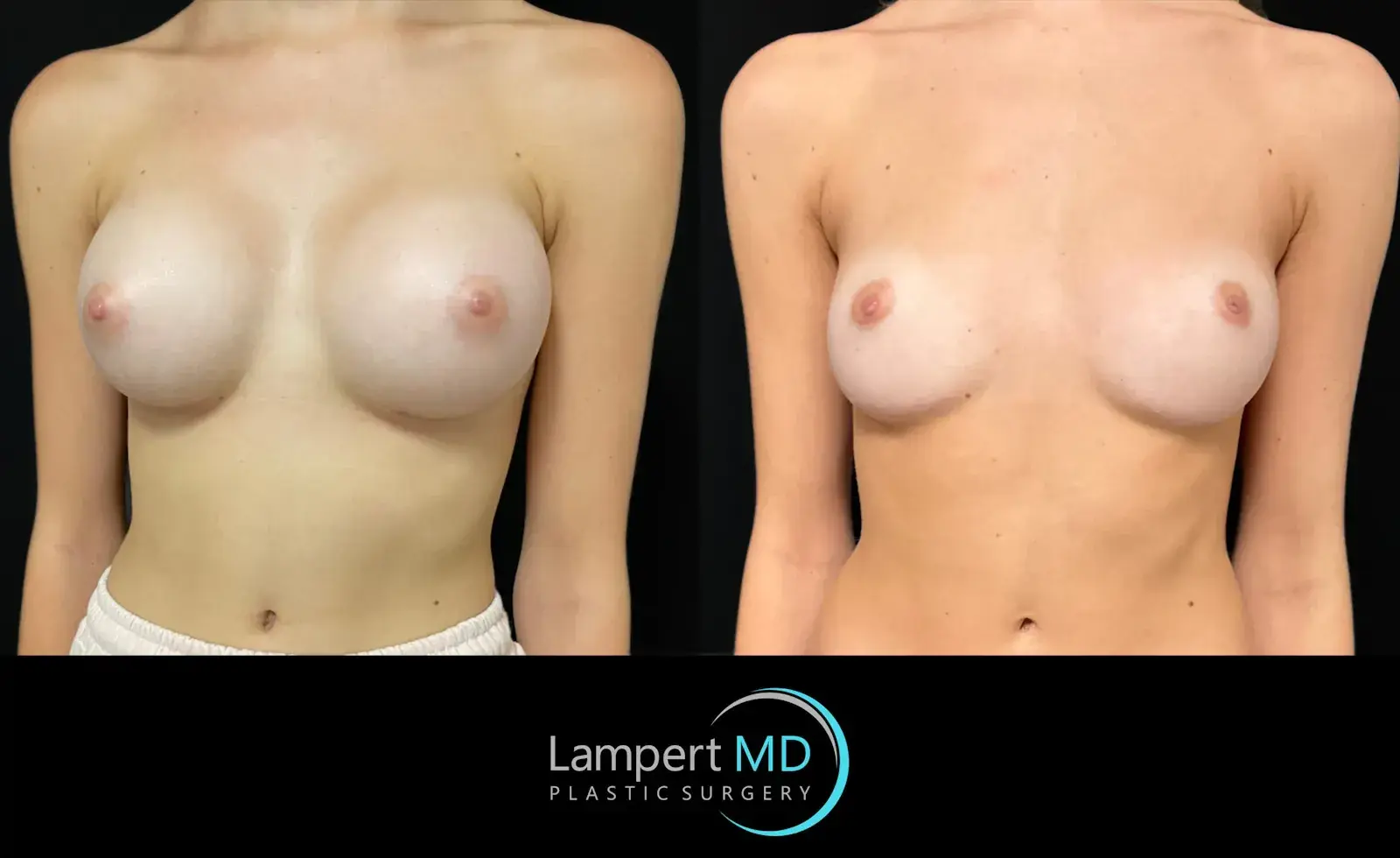 Dr. Joshua Lampert Plastic Surgery breast implant removal result — Aventura, FL
