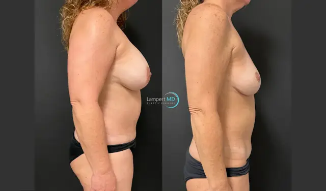 Mommy Makeover result at Dr. Joshua Lampert Plastic Surgery in Aventura, FL