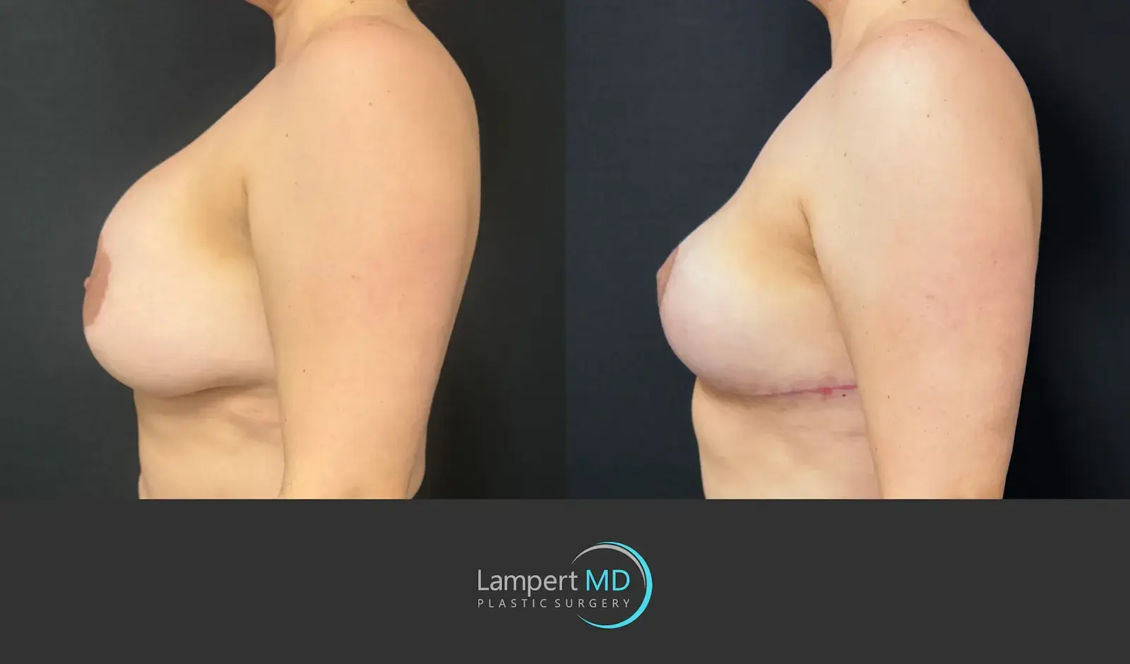 Dr. Joshua Lampert Plastic Surgery breast implant removal result — Aventura, FL