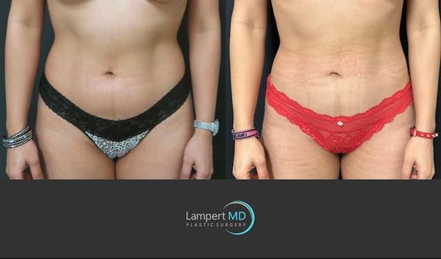 Liposuction result at Dr. Joshua Lampert Plastic Surgery in Aventura, FL