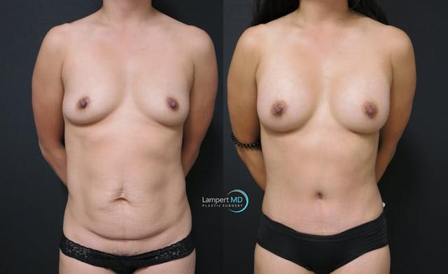 Mommy Makeover result at Dr. Joshua Lampert Plastic Surgery in Aventura, FL
