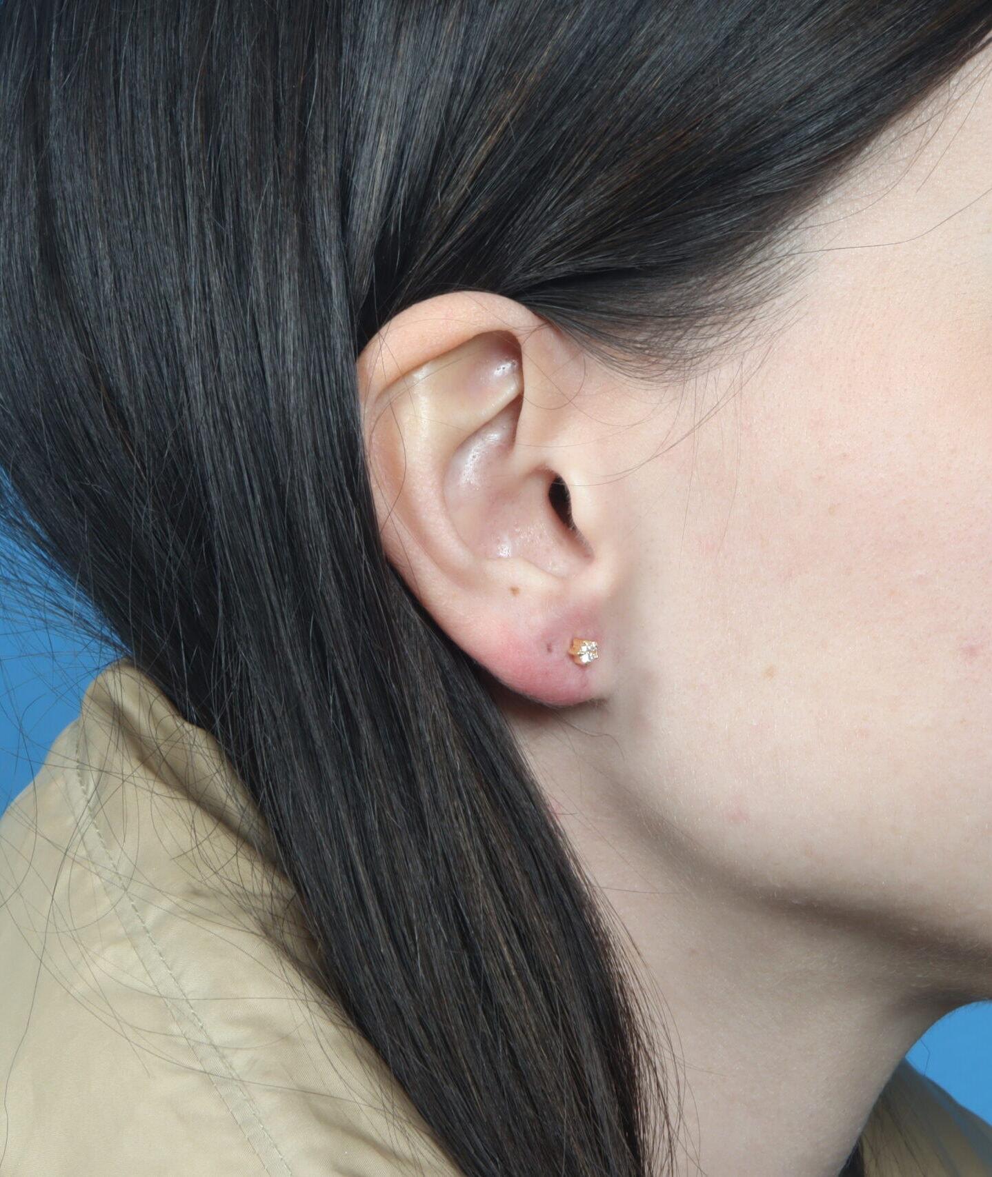Plastic Surgery Associates ear pinning after — Grand Rapids, MI